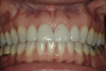 Figure 17  Correction of occlusal and gingival discrepancies was achieved by incorporating both orthodontics and restorative dentistry into the treatment plan.