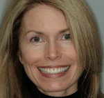 Figure 18  Full-face smile showing improved esthetics.