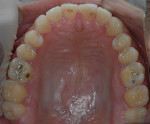 Figure 1  Initial aspect of superior teeth. Areas of mild wear in posterior occlusal surfaces mainly in the first molars can be noted.