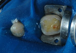 Figure 6  Self-etch adhesive system applied on all teeth surfaces followed by light-curing.
