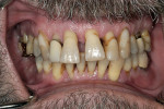 Figure 3  Anterior teeth have drifted into a splayed appearance.