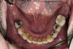 Figure 5  Lower molars lost due to periodontal disease.