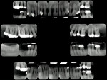 Figure 6  Full-mouth radiographs taken 1 year previously.