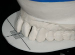 Figure 7  An esthetically oriented platform was used to communicate desired tooth position.
