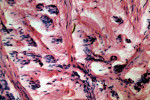 Figure 6  Photomicrograph of cellular fibroblastic connective tissue with islands and strands of odontogenic epithelium (hematoxylin and eosin stain, x40).