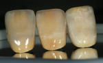 Figure 6  Clear fluorescent applied with facial glazing.