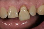 Figure 8  Crown for tooth No. 9 tried in.