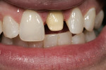 Figure 10  Translucency and mamelon enamel overlay check performed during hydration.