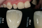 Figure 13  Staining defined by Chairside Shade Selection Guide as AS-3.