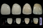 Figure 14  Chairside Shade Selection Guide offers four different stages of decalcification, or anterior stain.