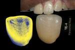 Figure 15  Photoshop<sup>®</sup>-adjusted image comparing patient texture with shade guide samples.
