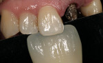 Figure 17  Tooth texture with irregular lobe and reflection.