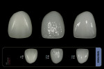 Figure 18  Sample crowns compared to the Chairside Shade Selection Guide.