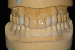 Figure 9   Second diagnostic wax-up done after orthodontic and bleaching therapy.