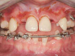 Laser Assisted Peri-Implantitis Procedure: An Alternative to Traditional Surgical Therapy Webinar Thumbnail