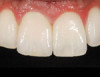 Fig 11. The digital template is then shifted onto the teeth on the left side at the gingival margins.
