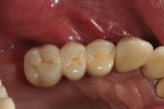 Figure 4  Intraoral photograph with definitive bridge in place; occlusal view of the first quadrant rehabilitation.