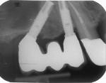 Figure 7  Representative periapical radiograph of a partial rehabilitation in the posterior maxilla (right side) with the anterior implant placed in the axial position and the posterior implant tilted distally. Implants with 5 years of follow-up.