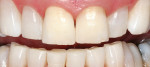 Figure 1 KöR Whitening is so effective that it can handle even tetracycline stains, offering a solution for every patient type.