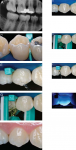 Figure 5 Clinical application of interproximal resin infiltration step-by-step: (A) Bite-wing radiograph with lesions on the distal of the first and mesial of the second maxillary right premolar. (B) Soft-tissue isolation with rubber dam. (C) Application 
