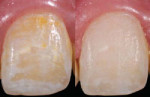 Figure 6 Resin infiltration on facial white spot lesions before (left) and after (right) treatment.