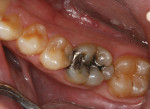 Preoperative occlusal view of the defective amalgam restoration on tooth No. 30 and mesial decay on tooth No.