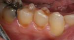 Postoperative view of the cervical restorations completed during the milling process.