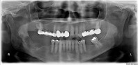 You Can't Treat What You Can't See-A Preferential Technology in Intraoral Radiography Webinar Thumbnail