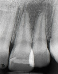 Figure 3 Five-year postoperative radiograph of first reattachment showing dentin bridge formation and periapical health.