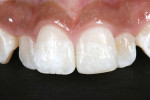 Figure 10 One year after touch-up of mesial-incisal area.