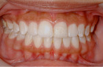 Figure 12 Photograph at 4.5-year recall showing tooth still intact following orthodontic treatment.