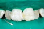 Figure 7 Reattached fragment in place before completion of restoration. Note the new fracture of the mesial-incisal angle.