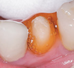Figure 3 In cases with a thinner gingival biotype, Racegel can be used as the sole source of hemostasis and tissue retraction.