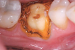 Figure 4 In this case Racegel was being used in conjunction with a packed cord to control gingival bleeding and to aid in tissue retraction.