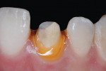 Figure 8 An anterior crown preparation. This tooth had an average gingival biotype, which allowed the use of Racegel as the sole source of gingival retraction.