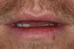 Figure 3. Lips in repose revealed a lack of incisal display. The patient desired more incisal tooth display.