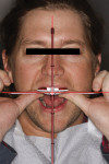 Figure 8. A photograph of the face-bow transfer with accessory reference lines was sent to the laboratory technician for orientation verification.