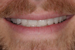 Figure 15. The patient’s smile showing harmonious tooth lengths that follow the natural curvature of the lower lip.