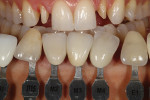 Figure 3 - Custom shade tabs ascertained gingival and incisal color as well as surface texture.