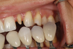 Figure 4 - Custom shade tabs ascertained gingival and incisal color as well as surface texture.