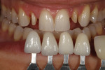 Figure 5 - Custom shade tabs ascertained gingival and incisal color as well as surface texture.