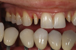 Figure 6 - Custom shade tabs ascertained gingival and incisal color as well as surface texture.