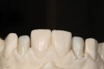 Figure 7 - Zirconia copings for teeth Nos. 7 and 10 were placed on the cast model.