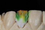 Figure 12 - Inside dentin colors.
