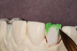 Figure 19 - Regular dentin A1 and translucency modifier were applied.