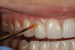 Figure 33 - Lustre pastes were applied to the gingival and incisal one-third areas indicated.