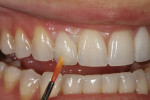 Figure 34 - Lustre pastes were applied to the gingival and incisal one-third areas indicated.