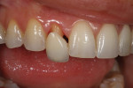 Figure 35 - The restorations were tried in the patient’s mouth.