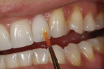 Figure 42 - A final touch up for tooth No. 10 was made to the area indicated.