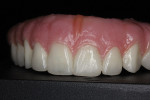 Figure 26  Labial aspect of the maxillary hybrid.